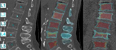 Finite Element Analysis of Osteoporotic and Osteoblastic Vertebrae and Its Association With the Proton Density Fat Fraction From Chemical Shift Encoding-Based Water-Fat MRI – A Preliminary Study